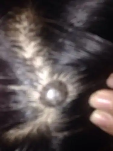 在头上长了个痣 不疼不痒 用不用割 割的话多钱