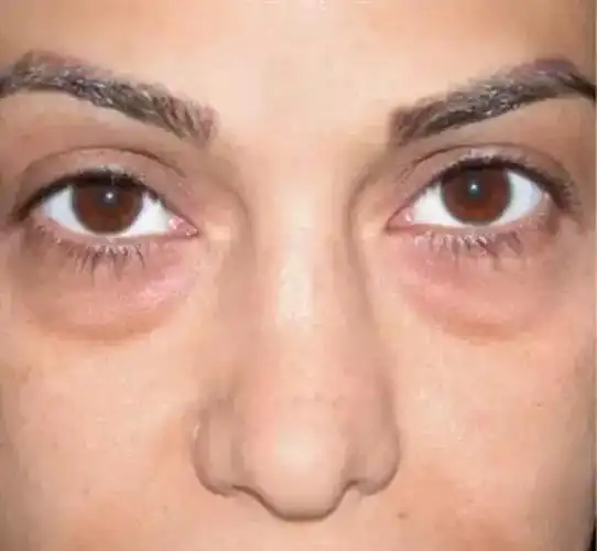 一个鸡蛋就能消除眼袋