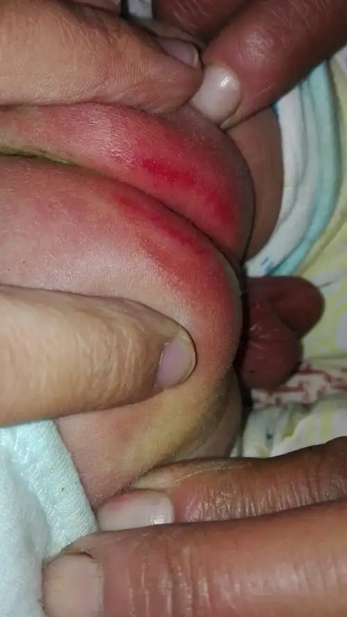 宝宝屁屁红有些破皮