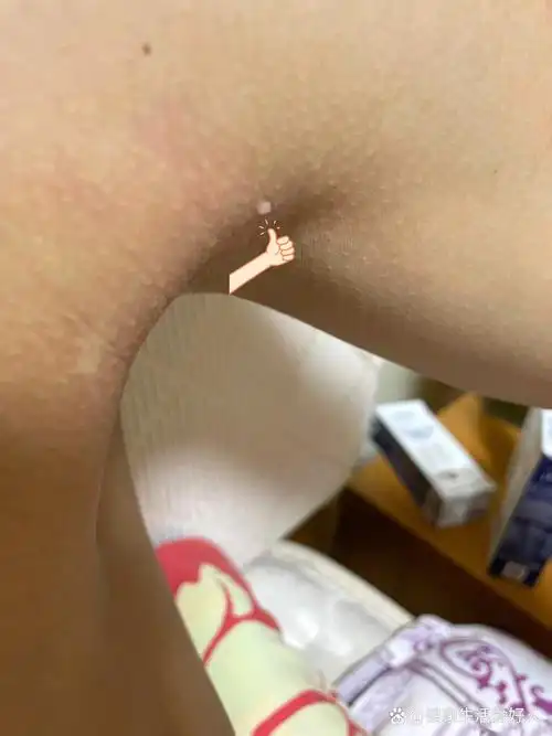 兄弟们重视起来!女朋友hpv感染扁平疣了!