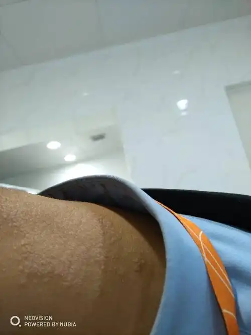 脖子侧面 有一块增厚又痒的 是什么癣?