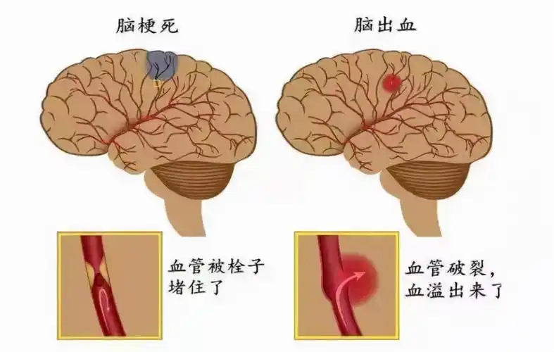一类是脑出血,叫出血性的脑卒中.