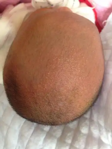 宝宝头上长了许多红点,里面有白色.