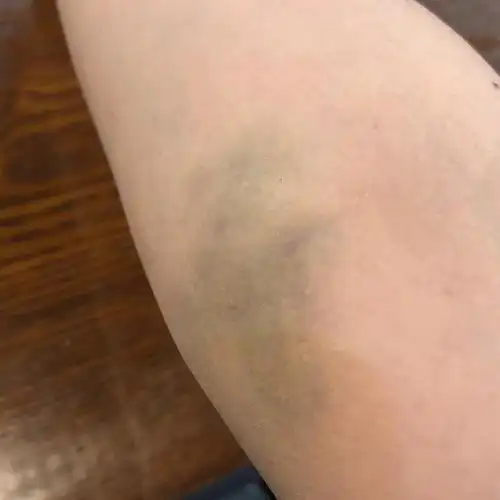 有没有跟我一样的网友,胳膊,腿啊哪里碰一下就紫了