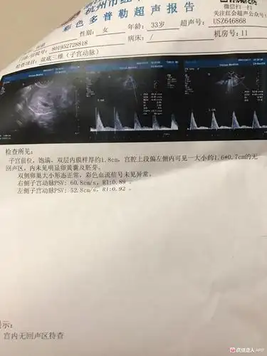 [试管婴儿]移植18天b超看见孕囊长得宫腔上段偏左测医生说怕是宫角孕?