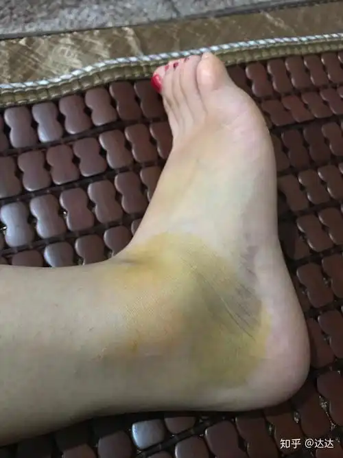 脚踝扭伤全记录
