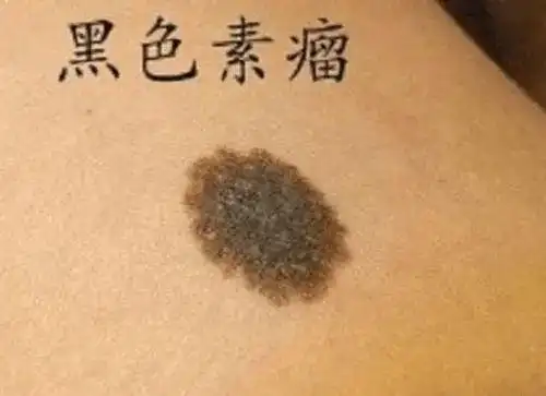 身上长这种痣的人肝多半不好千万别大意赶紧对镜自查