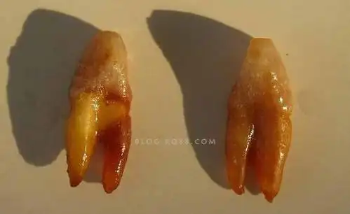 双根尖牙两枚并不罕见