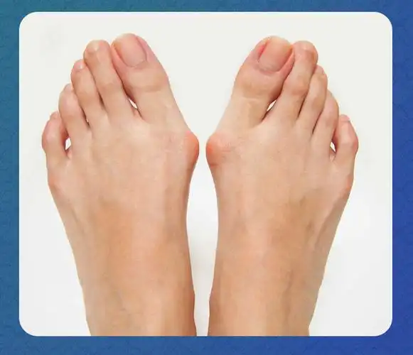 适用于拇指外翻矫正器【可拫冶】严重拇外翻大脚拇指外翻脚趾重叠疼