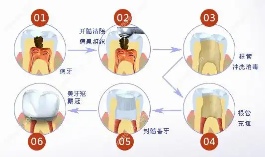 根管治疗步骤waasee.com