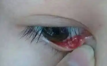 是息肉吗?不痛不痒都长了一个月了.好像是上火引起的.