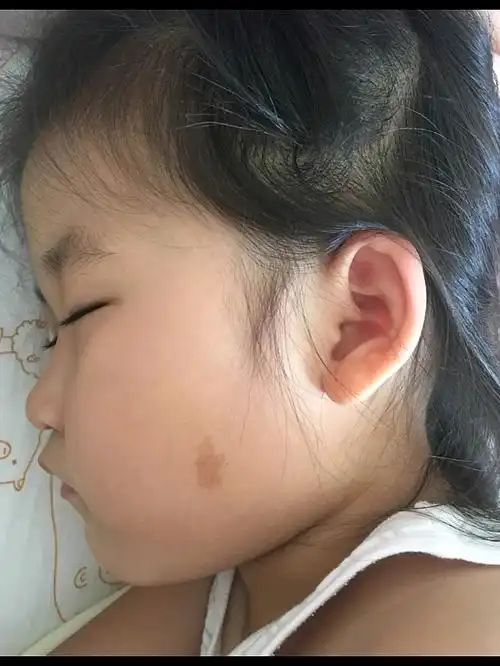 小孩出生几天后发现左脸侧一点点咖啡色印记,网上查了_圈子-新氧美容
