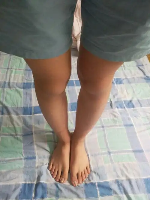 什么是o型腿我这个是o型腿吗,是不是不能当兵?