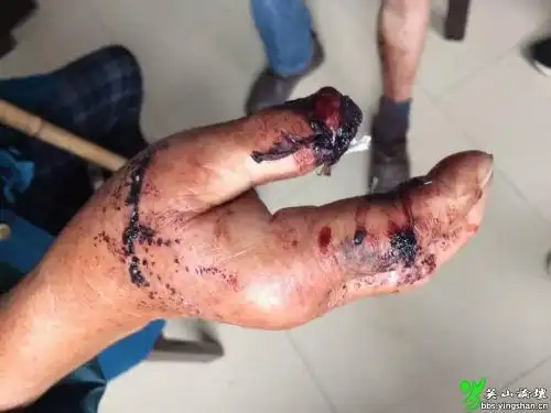 内容简介:疯狗咬人图片,疯狗咬人视频,狂犬病为什么会学狗叫,温州疯狗