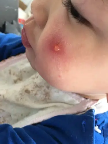 两岁脸上长水泡,昨天晒了一个上午,下午就这样了,咋办?