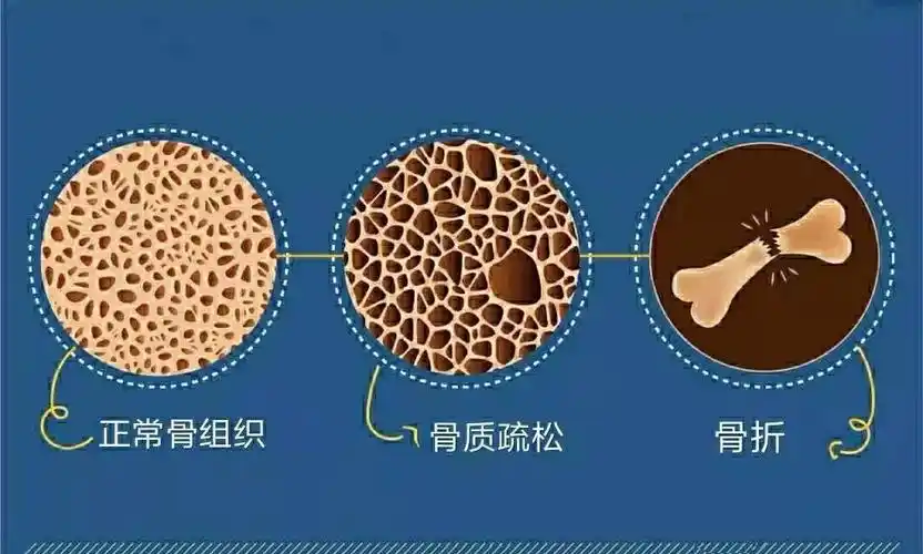 骨质疏松症是一种骨量减少,骨组织微结构破坏,导致骨骼脆性增加,易