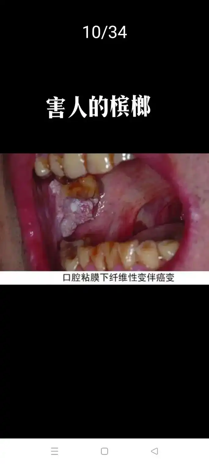 为了你和家人,请戒掉这害人的槟榔吧? - 抖音