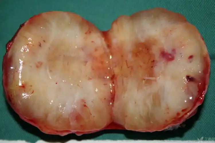 【讨论】看看这个腹部包块是什么?有病理结果 [病例帖]