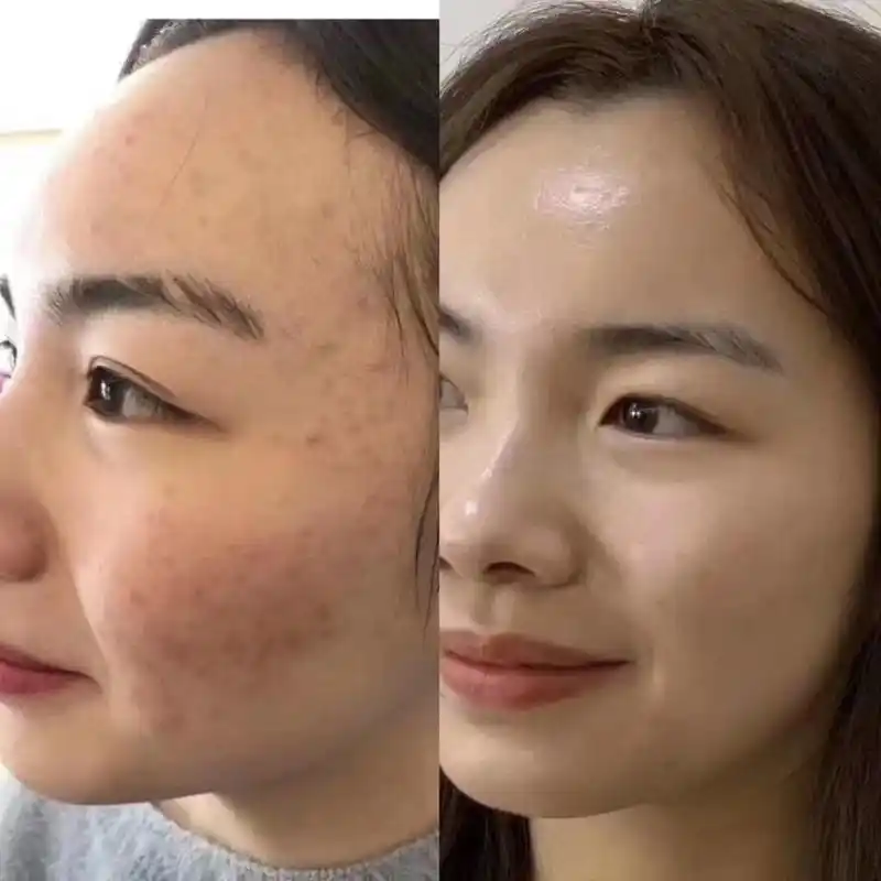 祛痘反馈来一组 还嫌天天敷面膜麻烦吗? 这样的效果不值得去麻烦吗?