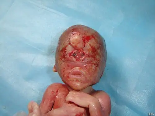 全前脑一例(有引产后图片)