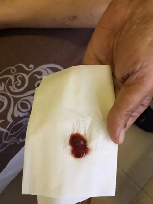 化疗联合免疫治疗之后咳血