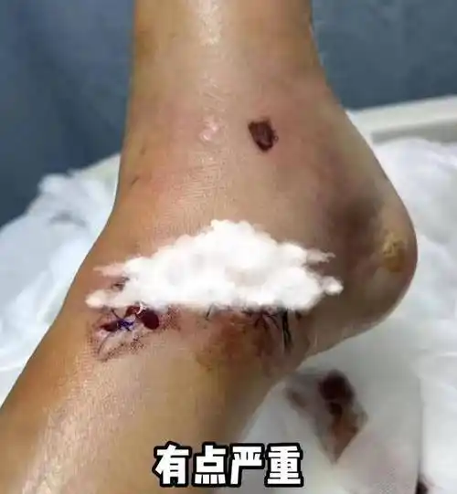 陈学冬车祸受伤,右腿受伤严重,打了几十个钢钉进去_作品_伤口处_因为