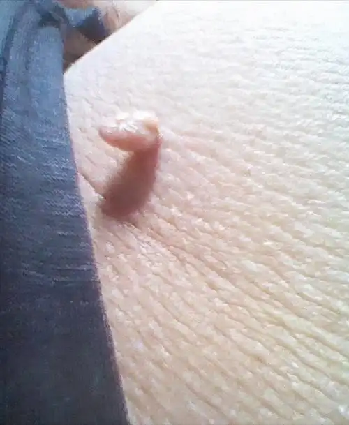 脖子上长了"小肉粒",碍事吗?要不要治疗?医生说明白了