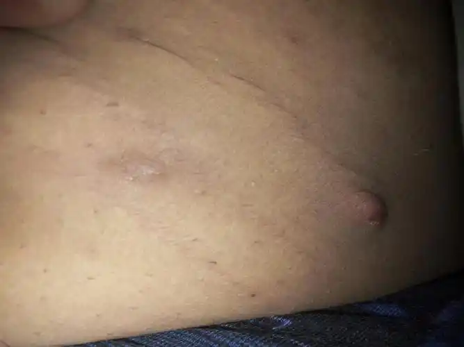 大腿内侧长了个疙瘩,不疼不痒,而且长在·生长纹·上,谁知道这个是