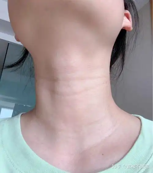 我才20岁,脖子又松弛皱纹有多,一圈圈很深的颈纹,怎么办? - 知乎