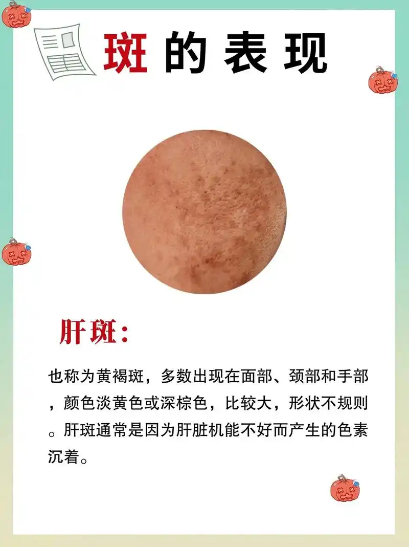 肝不好出现的肝斑图 - 抖音