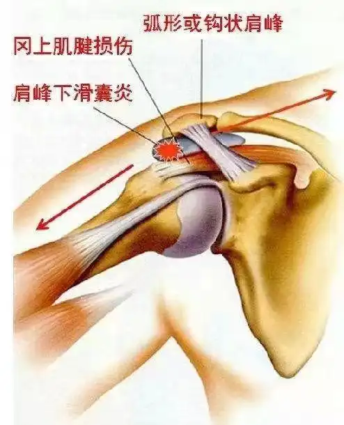 带您了解下,肩部疼痛之—肩峰下滑囊炎!
