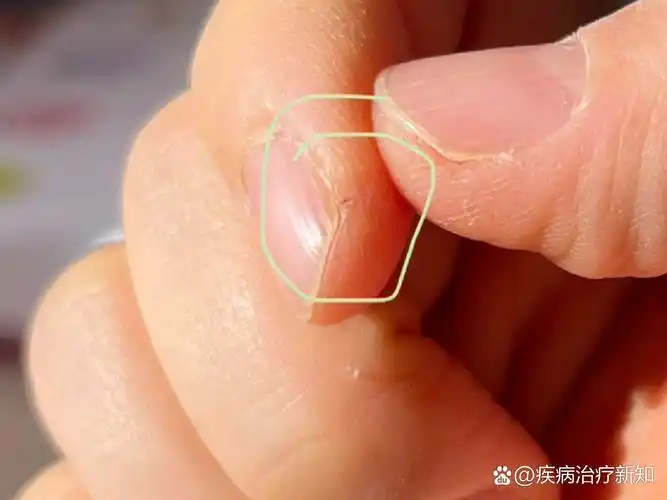 手指尖两边,靠近指甲的位置,每到冬天就开裂,这是怎么回事?