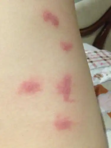 这样的疙瘩是被什么咬的,还可痒 ,怎么消除这些疙瘩?