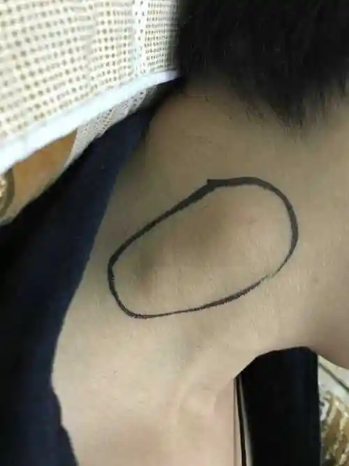 双侧腋窝淋巴结肿大