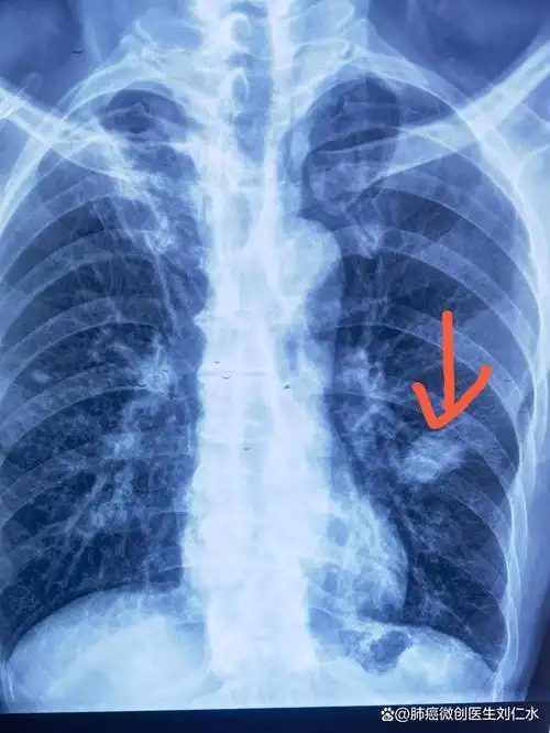 典型吸烟导致肺癌ct片,戒烟吧,烟民朋友