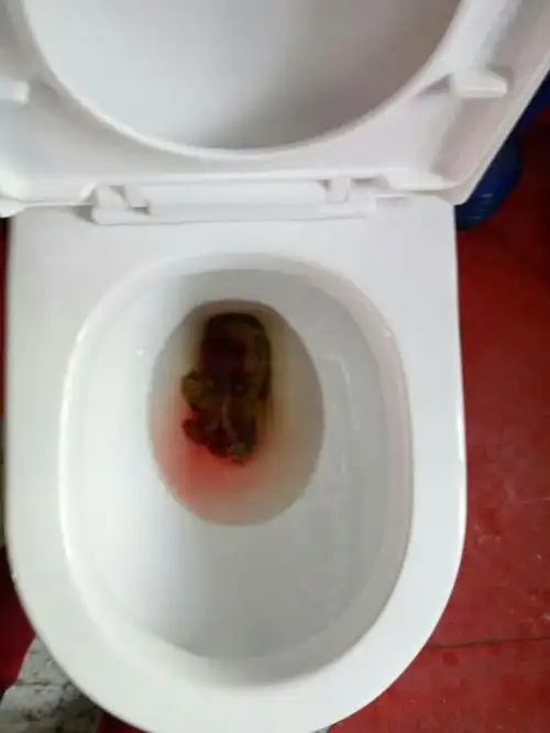 寄生虫感染,肿瘤等,所以对于大便带血,首要的任务是明确出血的原因