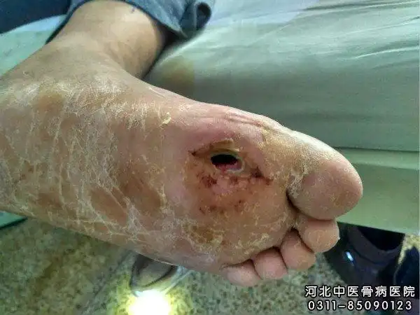 急性血源性骨髓炎的早期表现