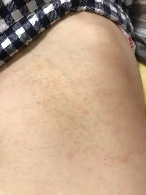 腰间一团皮肤是癣还是疹子?