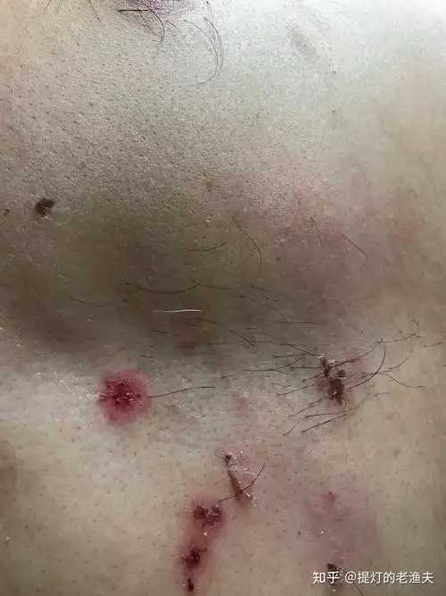 国内一种罕见的皮肤寄生虫在传播比疥螨更难治有病友被医生建议看精神