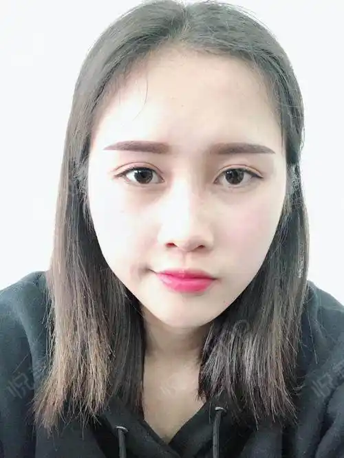 【南京美贝尔线雕隆鼻——自然清新小翘鼻】已经一个多月了,恢复很