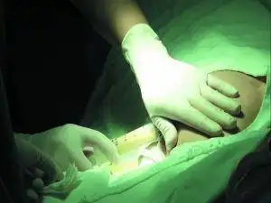 奥美定妈妈奶水被污染求医途中乳房爆裂