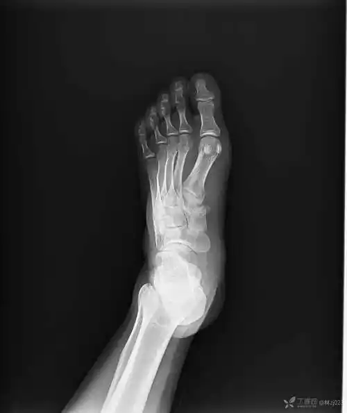 左足内侧楔骨见骨性突起