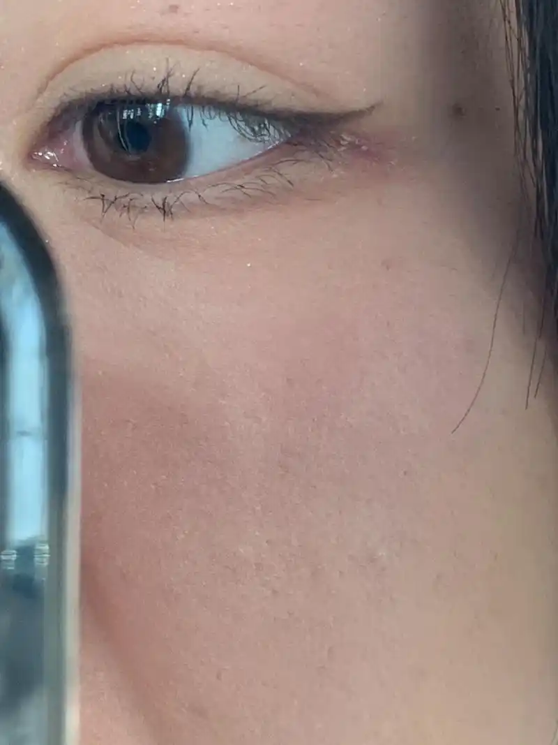 家人眼角起皮是什么情况07