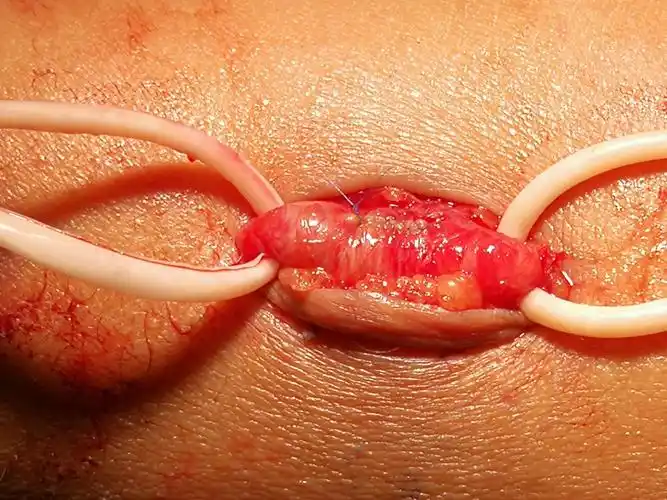 开放联合pta挽救瘘口狭窄所致avf血栓事件 - 美篇