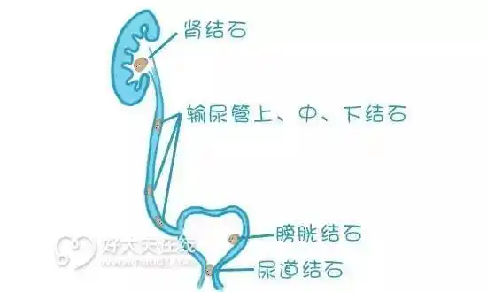 一颗"尿结石"的前世今生