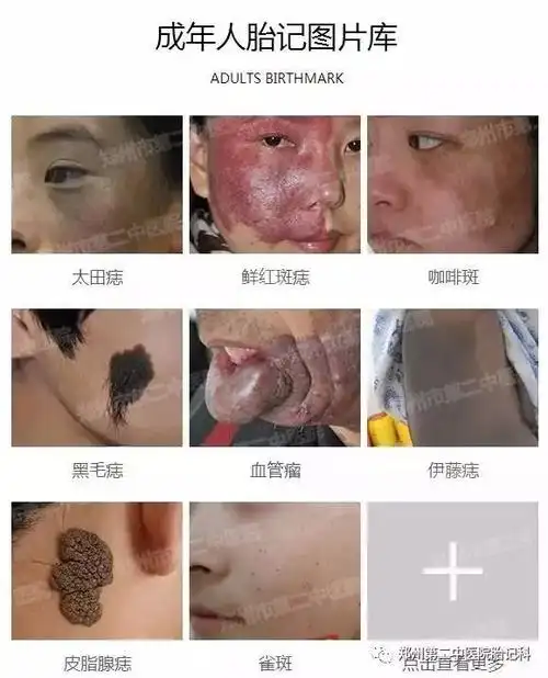你知道你的胎记是哪种吗?一起看图识胎记