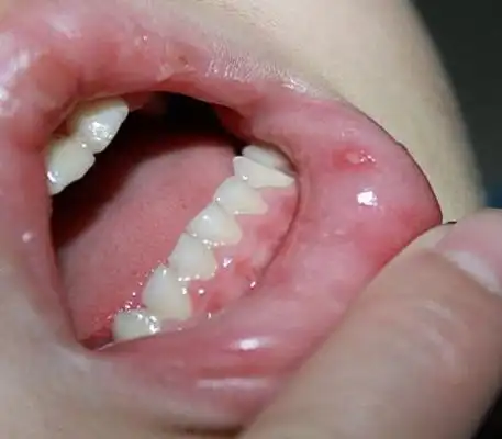 疱疹介绍_疱疹病因_疱疹治疗_疱疹医院医生_有来医生