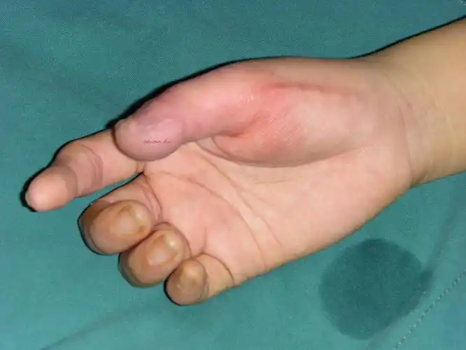 手指末节缺损修复 - 好大夫在线