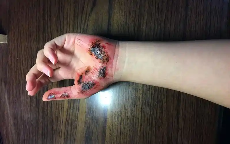 仿youtube博主powdah视频手掌擦伤严重