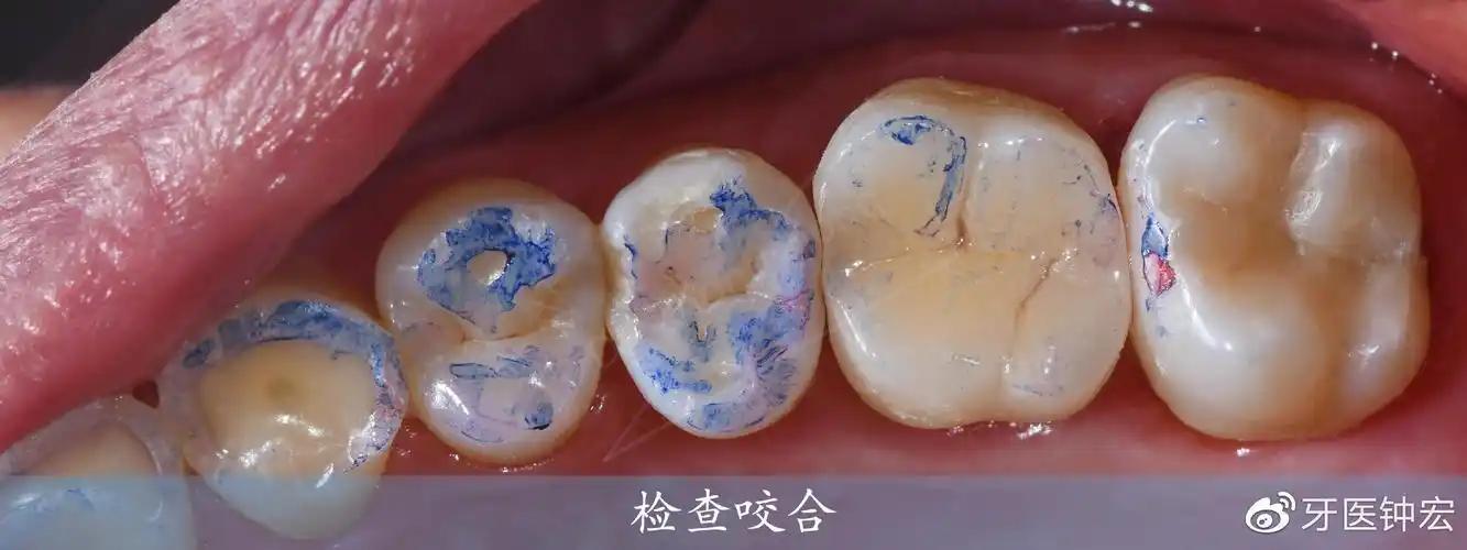 修复设计之高嵌体预备-左上磨牙区根管治疗及嵌体修复